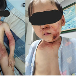 대고LCM 체험사례  – 아토피